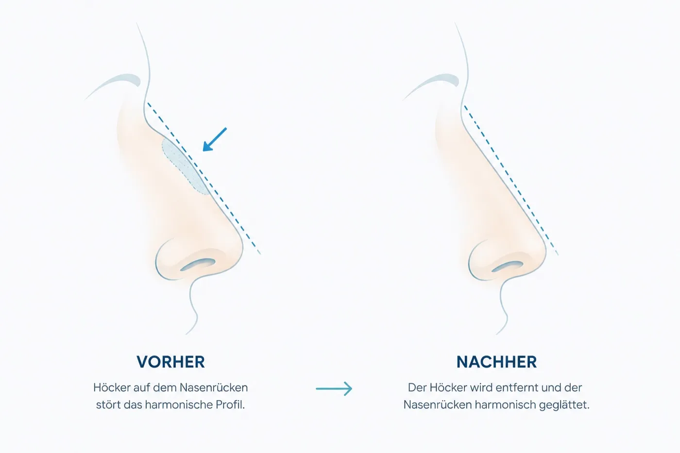 Nasenverkleinerung Schematische Darstellung — Vorher Nachher