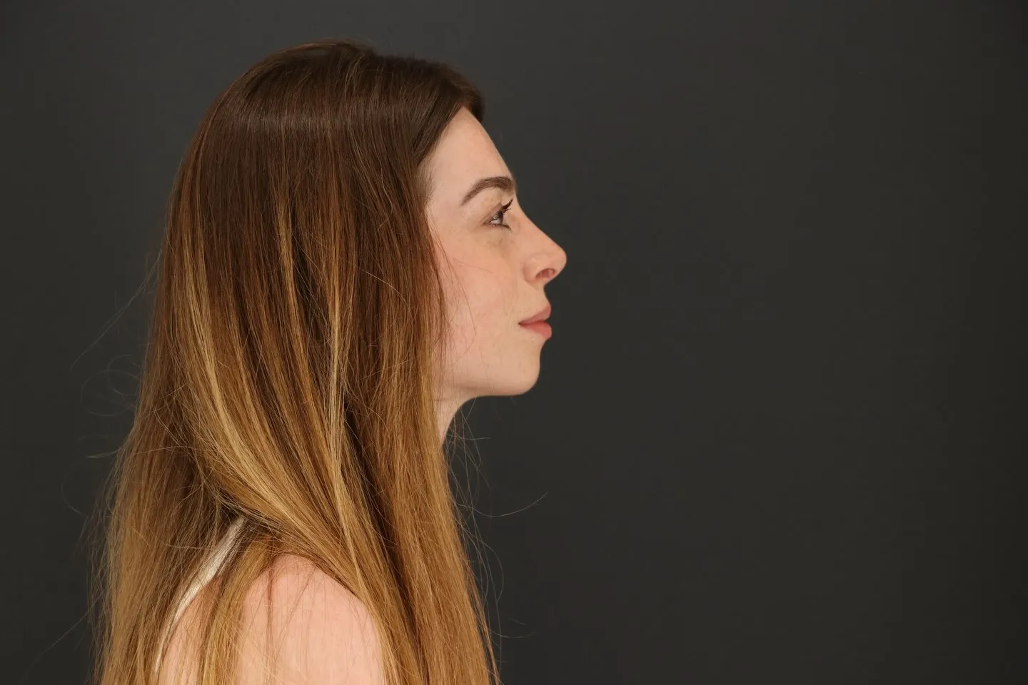 Nasenkorrektur Ergebnis — Profil rechts
