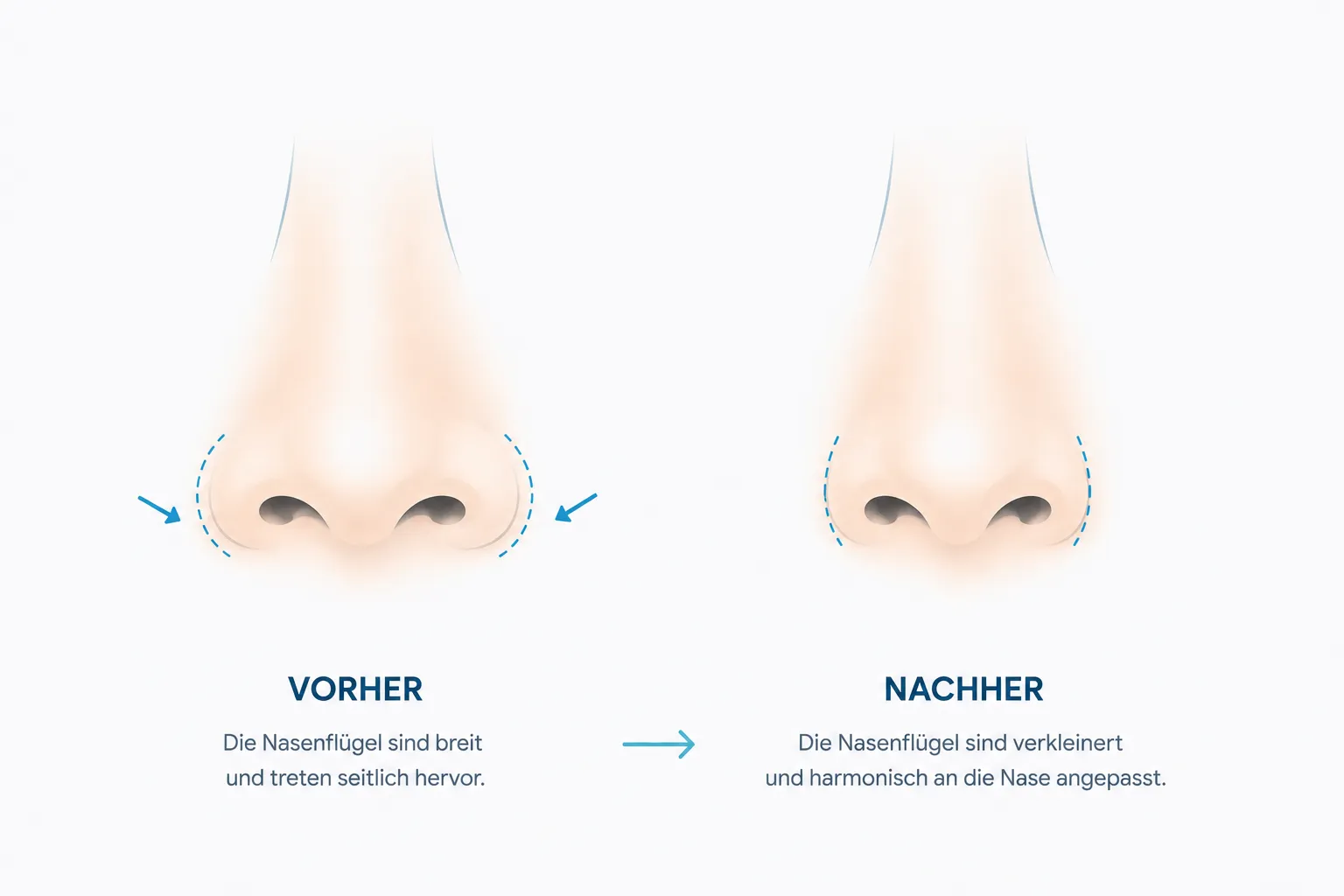Nasenflügel verkleinern Rosenheim — Vorher Nachher