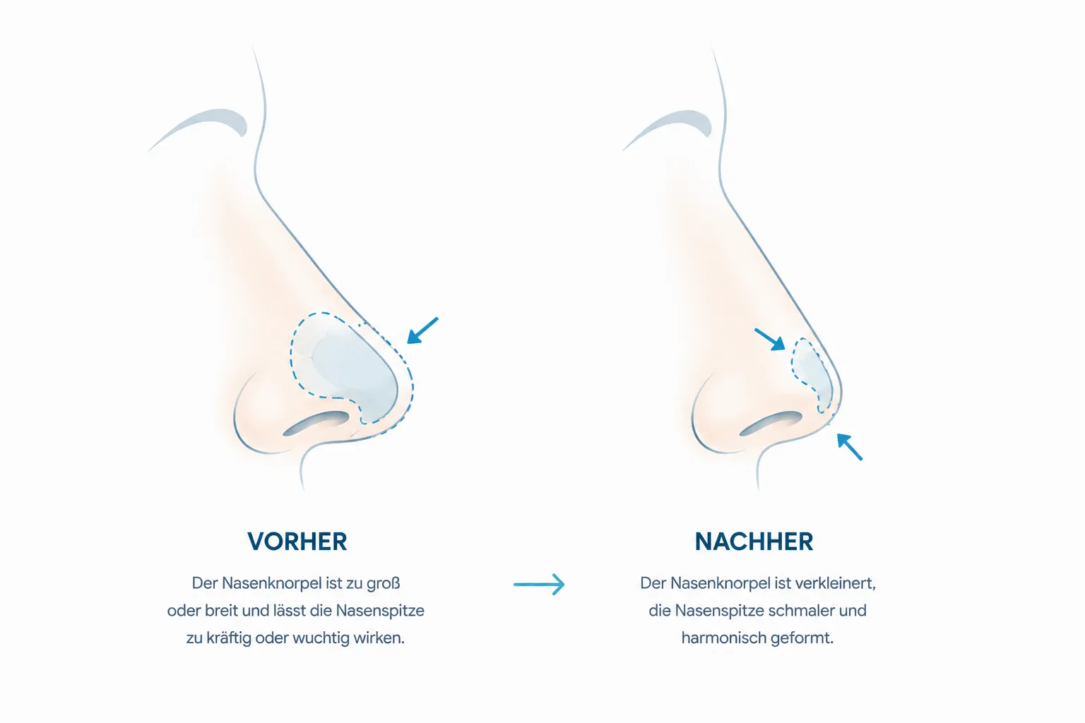 Nasenknorpel verkleinern — Schematische Darstellung Vorher Nachher