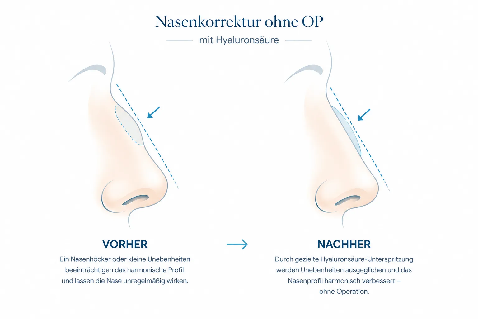 Nasenkorrektur Ohne Op Illustration