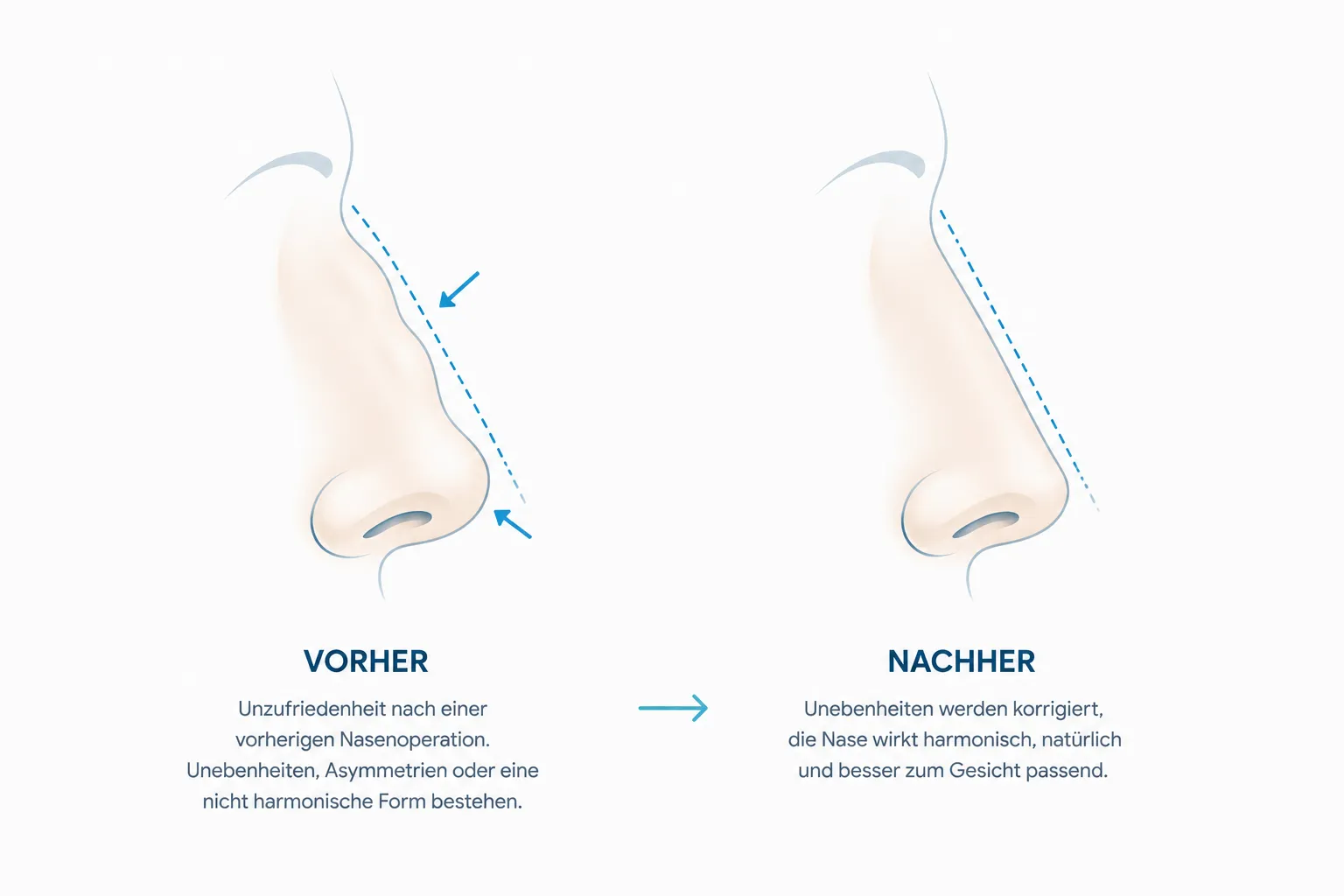 Nasennachkorrektur Rosenheim — Revision Rhinoplastik