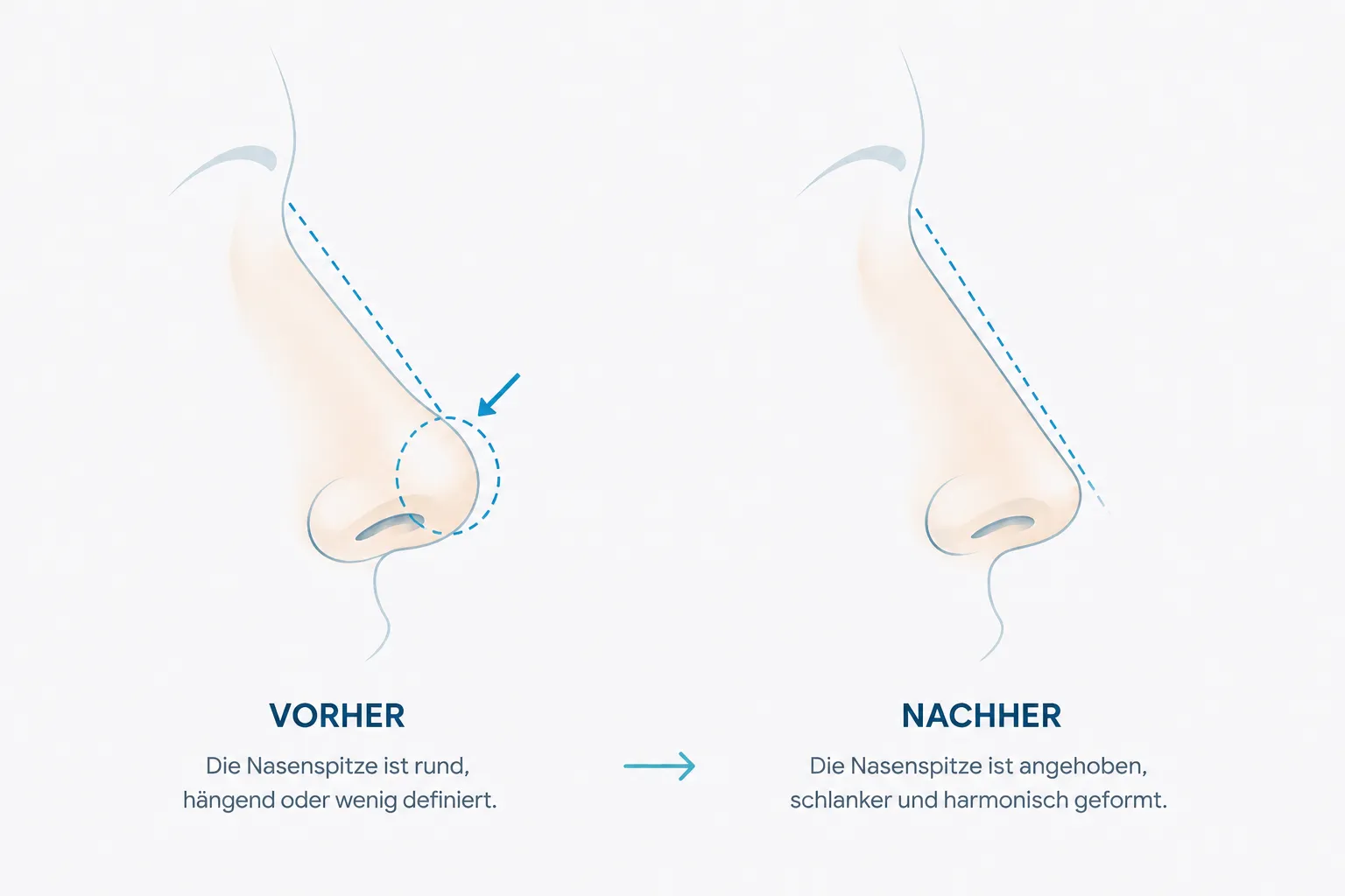 Nasenspitzenkorrektur Rosenheim — Vorher Nachher